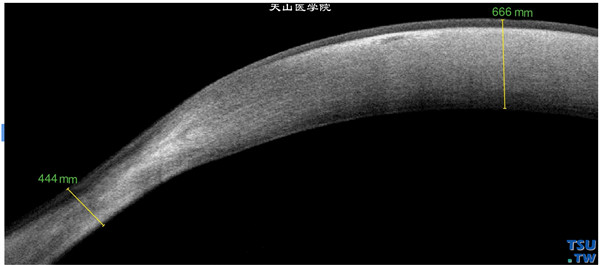 Terrien边缘变性，上图同一患者，RTvue OCT检查，可见周边角膜明显变薄，上皮层尚完整