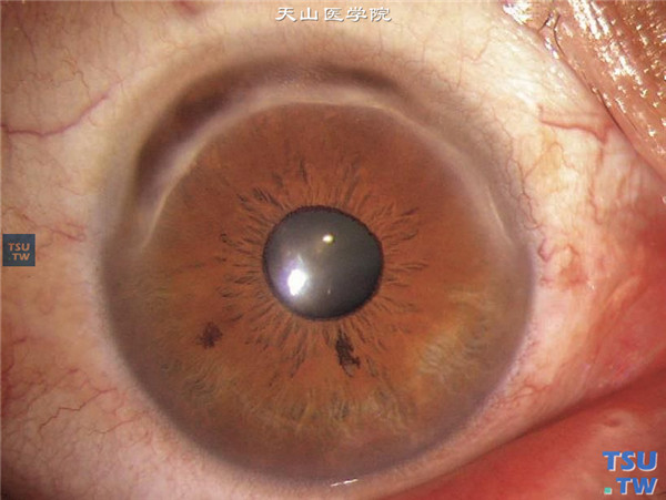 Terrien边缘变性，膨隆期，病程进展，可见上方角膜变薄，病变区角膜膨隆