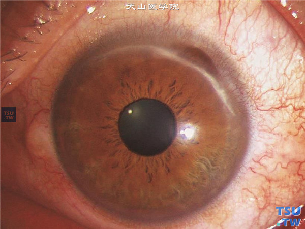 Terrien边缘变性，上图同一患者左眼，Terrien边缘变性，膨隆期，角膜病变范围较右眼小