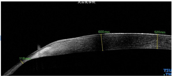 Terrien边缘变性，上图同一患眼，RTvue OCT检查，病变区角膜极度变薄，厚度仅有118mm，上皮层影像尚完整