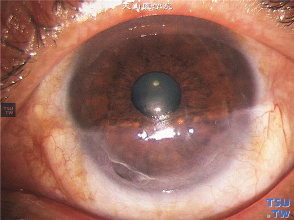 Terrien边缘变性，上图同一患者，行半圆形板层角膜移植术，术后随访2年，角膜植片透明
