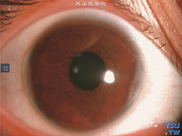 角膜带状变性的早期，病变起始于睑裂区角膜边缘部