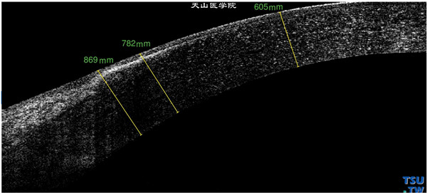 角膜带状变性，上图同一患者，RTvue OCT 检查，可见角膜浅基质层有片状混浊影像