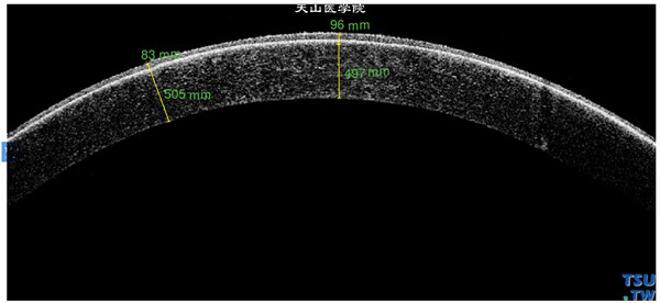 角膜带状变性，上图同一患者，RTvue OCT检查，可见角膜变性区在角膜前弹力层，病变区角膜上皮层增厚