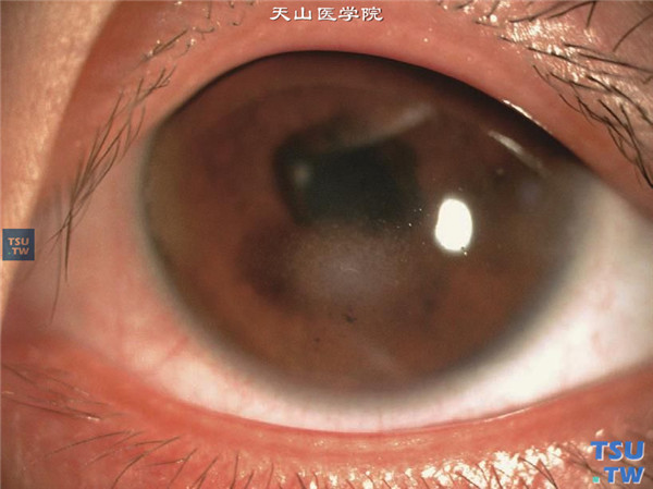 角膜带状变性，上图同一患者左眼，也见角膜上皮下或前弹力层出现带状混浊