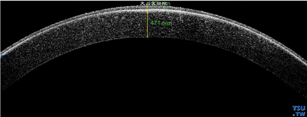 角膜带状变性患者，左眼RTvue OCT检查，显示角膜变性区在角膜前弹力层，前弹力层和上皮层均增厚