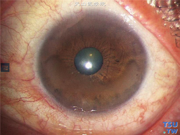 角膜带状变性，变性区在角膜下方，瞳孔区角膜透明
