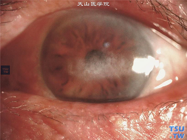 角膜带状变性，随着病情发展，变性区呈明显带状，横跨瞳孔区，视力受累