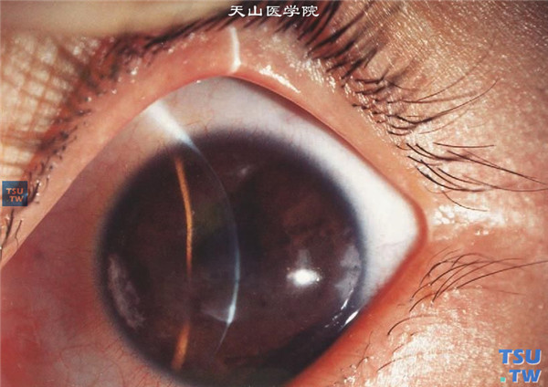 角膜带状变性，可见横跨瞳孔区的角膜带状变性区