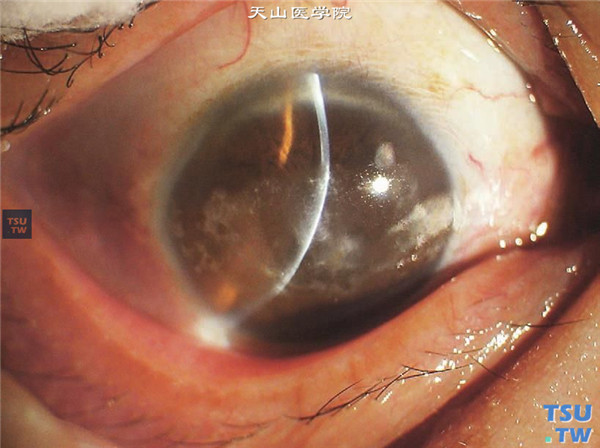 角膜带状变性，可见横跨瞳孔区的角膜带状变性区