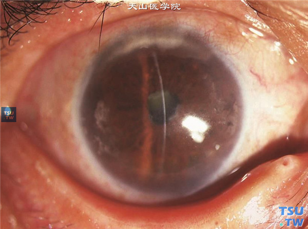 角膜带状变性，上图同一患者，行PTK联合羊膜移植治疗，术后随访8个月，中央区角膜透明，视力明显改善，无复发迹象