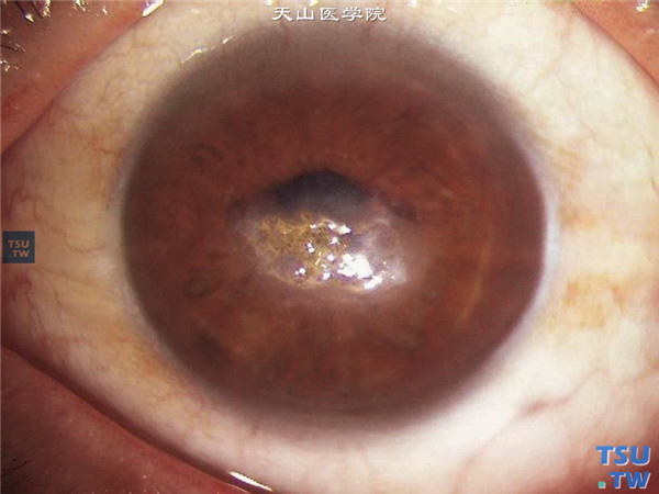 气候性滴状角膜变性症状图