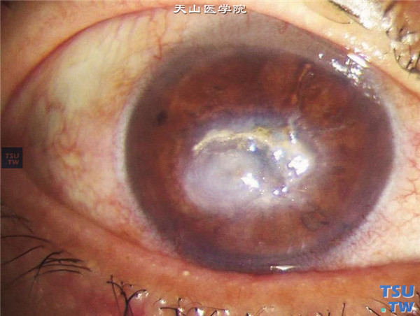 上述两张照片显示同一患者双眼气候性滴状角膜变性，可见双眼中央区角膜上皮下积聚乳白色和灰黄色油滴状物