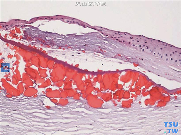 HE×200 以上两张图片显示气候性滴状角膜变性，从术中获取病变角膜片行组织病理学检查，HE染色，可见角膜上皮和浅基质层内颗粒状沉积物