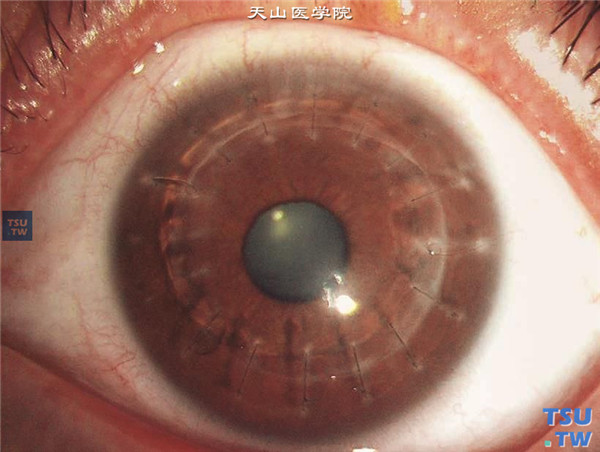 气候性滴状角膜变性，上图同一患者，行板层角膜移植术，术后随访18个月，角膜植片透明