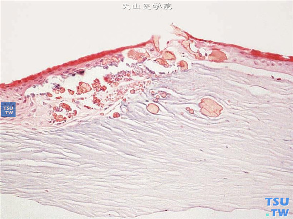 角膜脂质样变性，病变角膜片行组织病理学检查，HE染色，可见浅基质层内积聚大小不一，球形或椭圆形红染的变性物质 HE×100