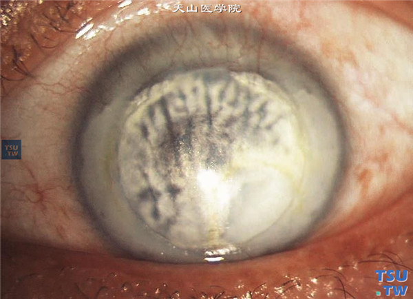 角膜脂质样变性，角膜呈不均匀黄白色混浊，上方角膜缘伴有新生血管，视力严重受损