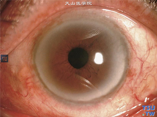 角膜老年环症状实图