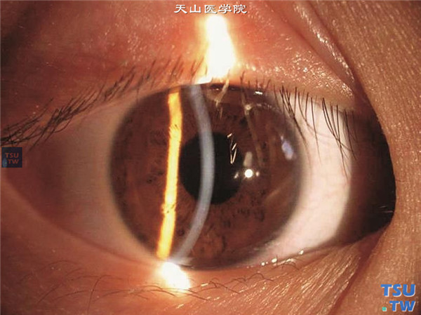 圆锥角膜潜伏期，右眼进行性近视，裂隙灯显微镜检查，表现正常角膜图像