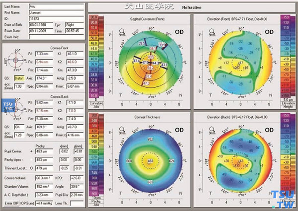 圆锥角膜，上图同一患者，角膜地形图显示最陡子午线平均角膜屈光力为48.6D；中央角膜厚度483mm；可见角膜大散光以及角膜后圆锥