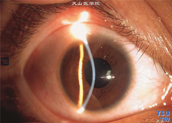 圆锥角膜患者，右眼圆锥角膜完成期，裂隙灯显微镜检查，角膜中央偏下前突，角膜变薄