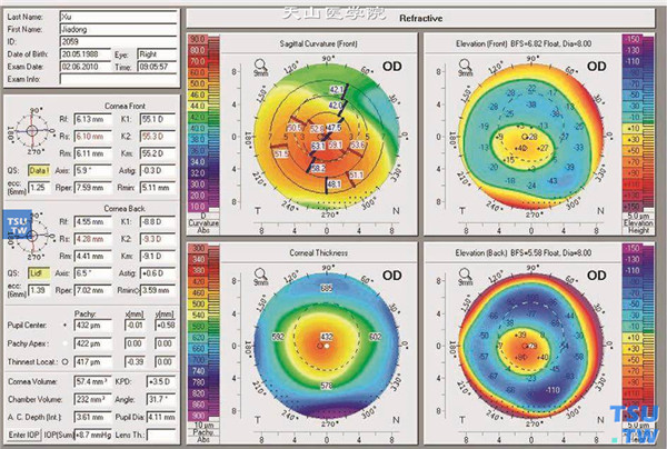 圆锥角膜，上图同一患者，角膜地形图显示最陡子午线平均角膜屈光力为55.3D；中央角膜厚度432mm，角膜有明显后圆锥