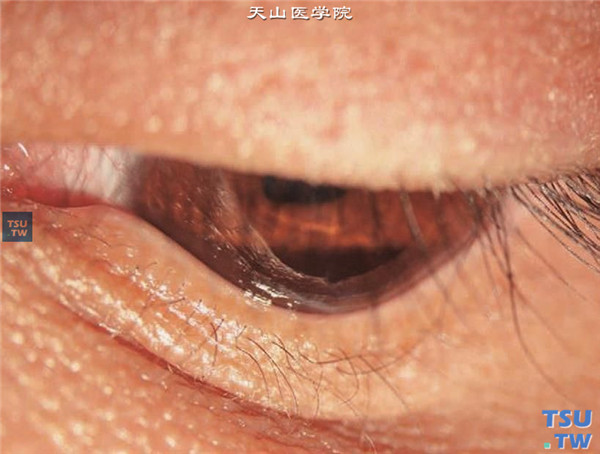 以上两张图片显示圆锥角膜完成期，Munson征阳性；患眼向下看时，下眼睑睑缘变形，呈锥状前突，称Munson征阳性