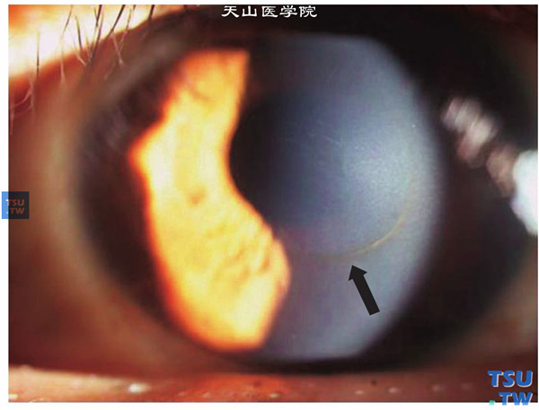 以上两张图片显示圆锥角膜完成期，可见Fleischer环；在角膜锥体的底部，角膜基质内有铁质沉着，为一棕褐色环，称为Fleischer环