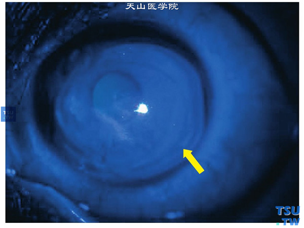  圆锥角膜完成期，Fleischer环