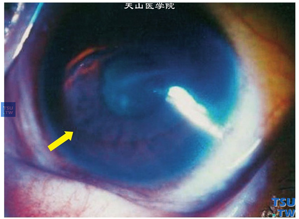 以上两张图片显示圆锥角膜完成期，Fleischer环，在裂隙灯的钴蓝色光下更易发现