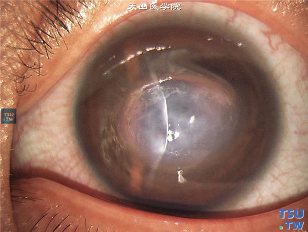 以上两张图片显示急性圆锥角膜，角膜中央后弹力层破裂，角膜基质突发水肿