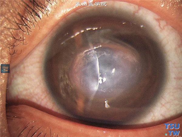 眼角膜水肿图片