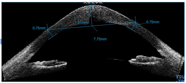 继发性圆锥角膜，上图同一患者Vistante OCT 检查，可见角膜明显锥状突起