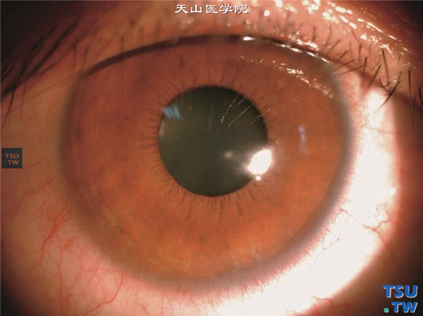 继发性圆锥角膜，患者LASIK术后14年，视力下降3个月，视力0.06，裂隙灯显微镜大体观，未发现异常