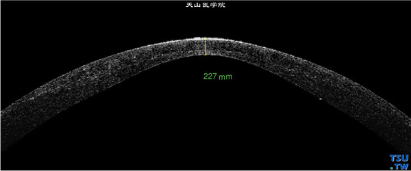 继发性圆锥角膜，上图同一患者，RTvue OCT检查，可见角膜明显前突变薄，角膜中央深基质轻度浑浊，角膜厚度仅有227mm