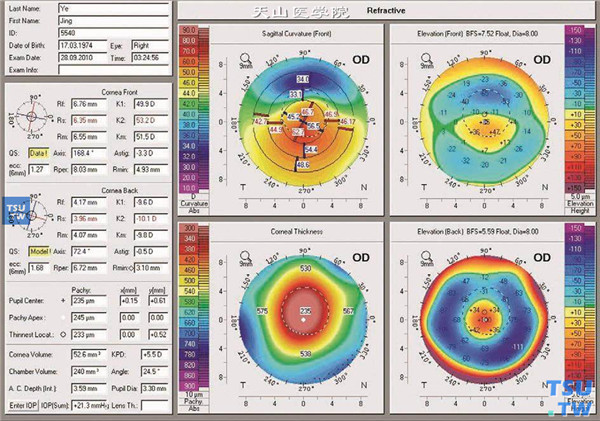 角膜地形图屈光四图图片