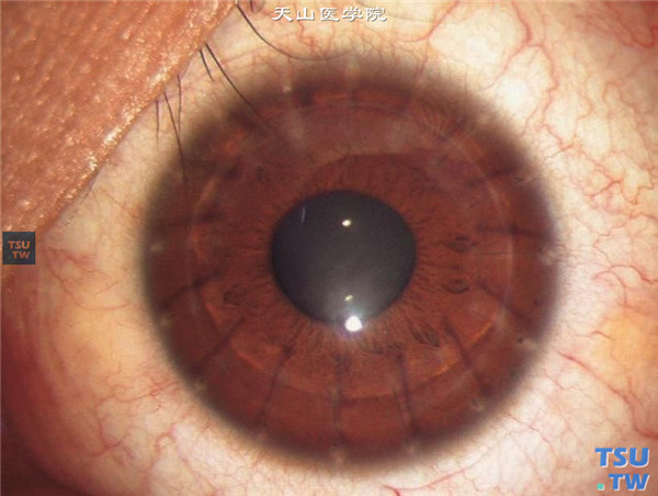 圆锥角膜完成期，上图同一患者，行深板层角膜移植术，术后随访20个月，角膜植片透明，视力0.6
