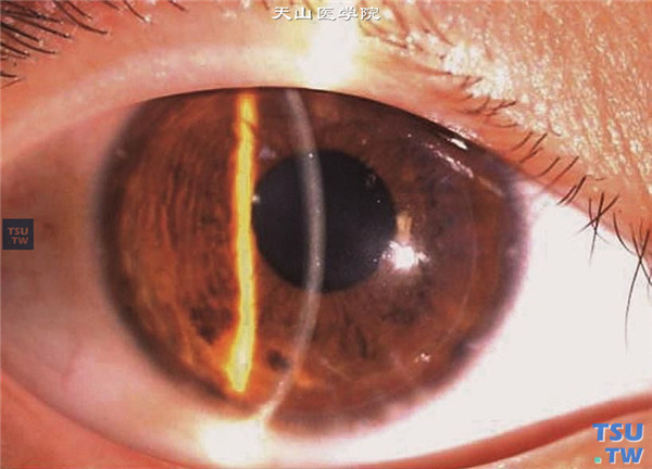 圆锥角膜完成期，上图同一患者，行深板层角膜移植术，术后随访4年，角膜植片透明，视力0.5