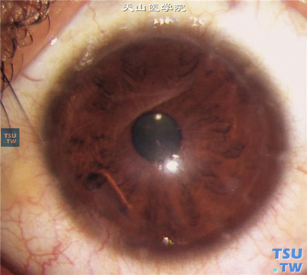 圆锥角膜完成期，行深板层角膜移植术，术后随访3年，角膜植片透明，裸眼视力0.1