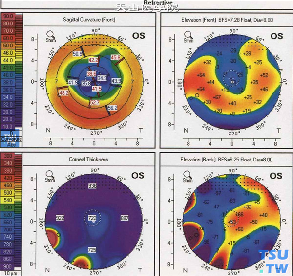 角膜地形图屈光四图图片