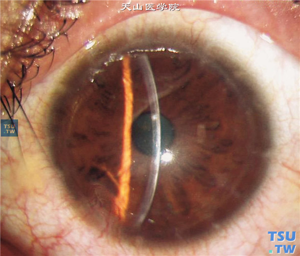圆锥角膜完成期，上图同一患者，行LASEK手术矫正角膜散光，术后随访2年，裸眼视力0.5