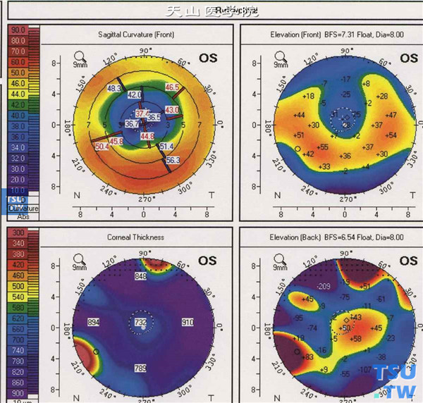 角膜地形图检查，显示最陡与最平子午线平均角膜屈光力为40.8/36.0@138°，残余角膜散光约4D