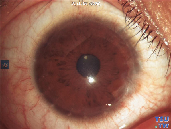 圆锥角膜完成期，行角膜表层镜片术，术后随访10年，右眼角膜植片透明，裸眼视力0.12