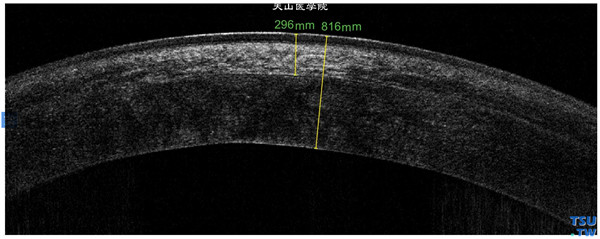 圆锥角膜，右眼RTvue OCT检查，角膜植片植床影像密度均一，可见植床界面，上皮层和内皮层完整