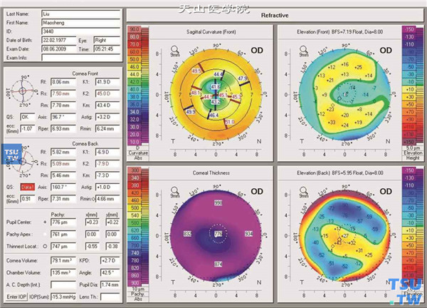 圆锥角膜，右眼角膜地形图检查，可见最陡与最平子午线平均角膜屈光力为45.0/41.9@97°，中央角膜厚度为776mm