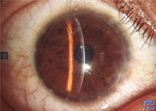 圆锥角膜，右眼行LASEK手术矫正角膜散光，手术后随访4个月，裸眼视力0.8