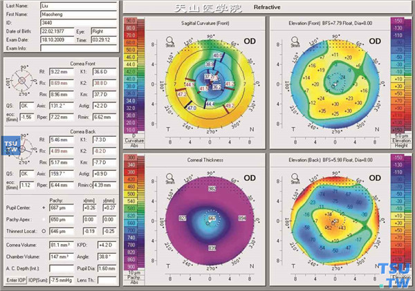 圆锥角膜，右眼LASEK术后角膜地形图检查，可见中央光学切削区最陡与最平子午线平均角膜屈光力为38.8/36.6@131°，中央角膜厚度为667mm