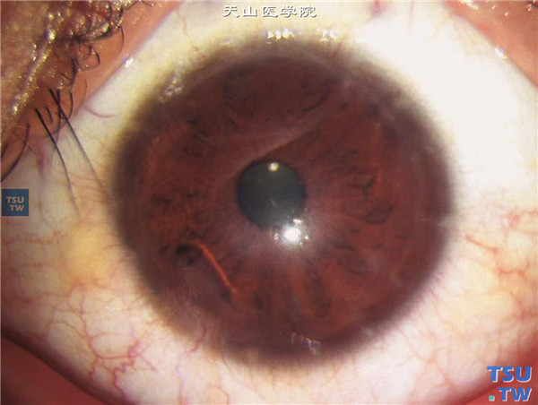圆锥角膜，同一患者左眼，病史同右眼，可见角膜植片透明，裸眼视力0.12