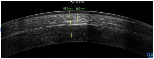 圆锥角膜，左眼RTvue OCT检查，与右眼相似