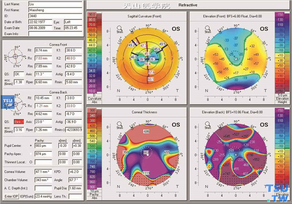 圆锥角膜，左眼角膜地形图检查，可见最陡与最平子午线平均角膜屈光力为40.0/38.6@11°，中央角膜厚度为800 mm